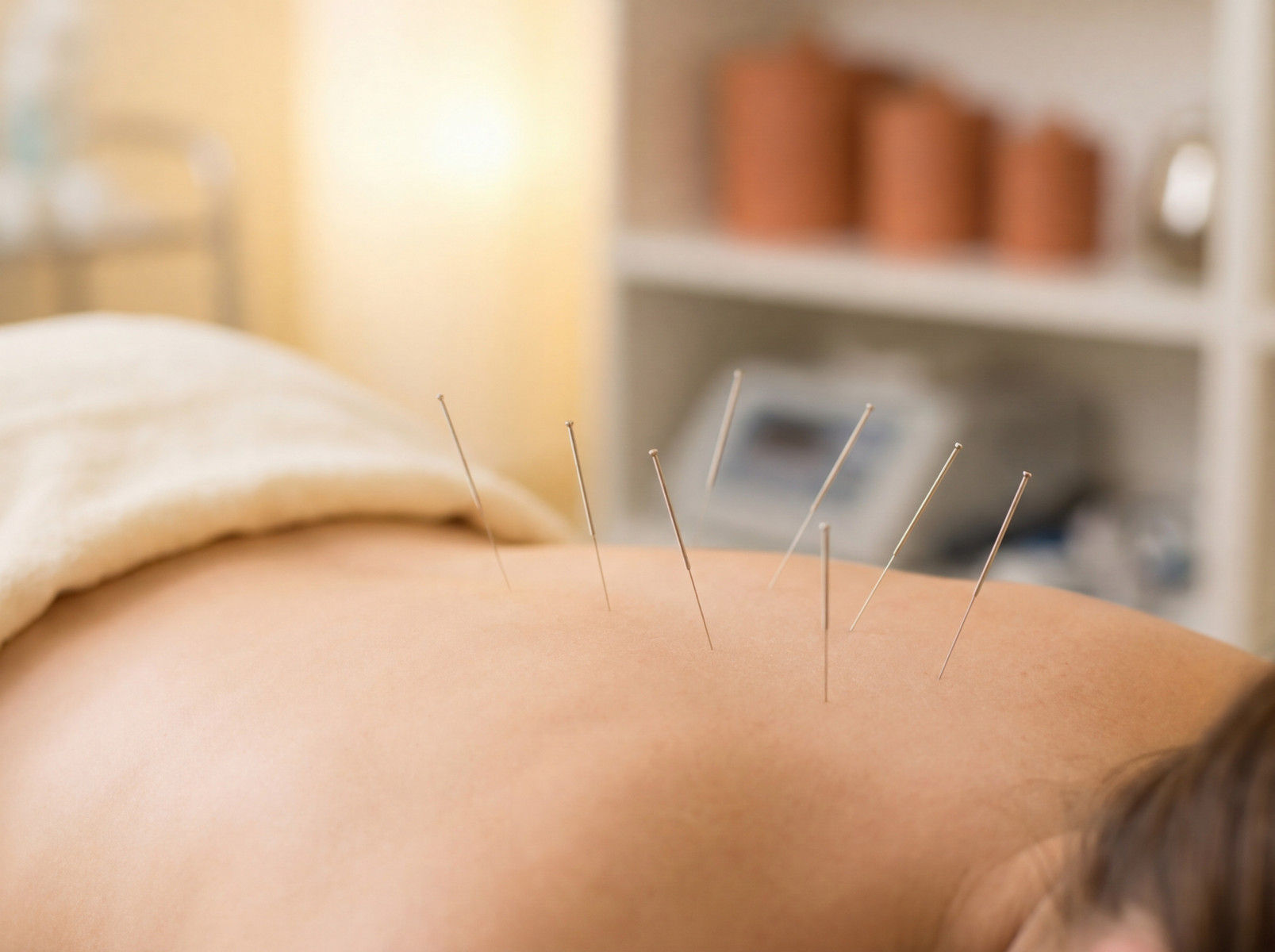 Acupuncture needles placed during a treatment session